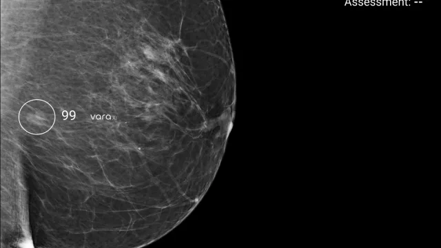 Quibim se alía con la alemana Vara para desplegar en España la IA para cribado de mama más avanzada de Europa